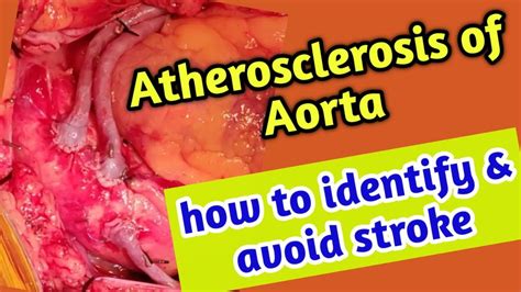 atherosclerotic aorta in tagalog